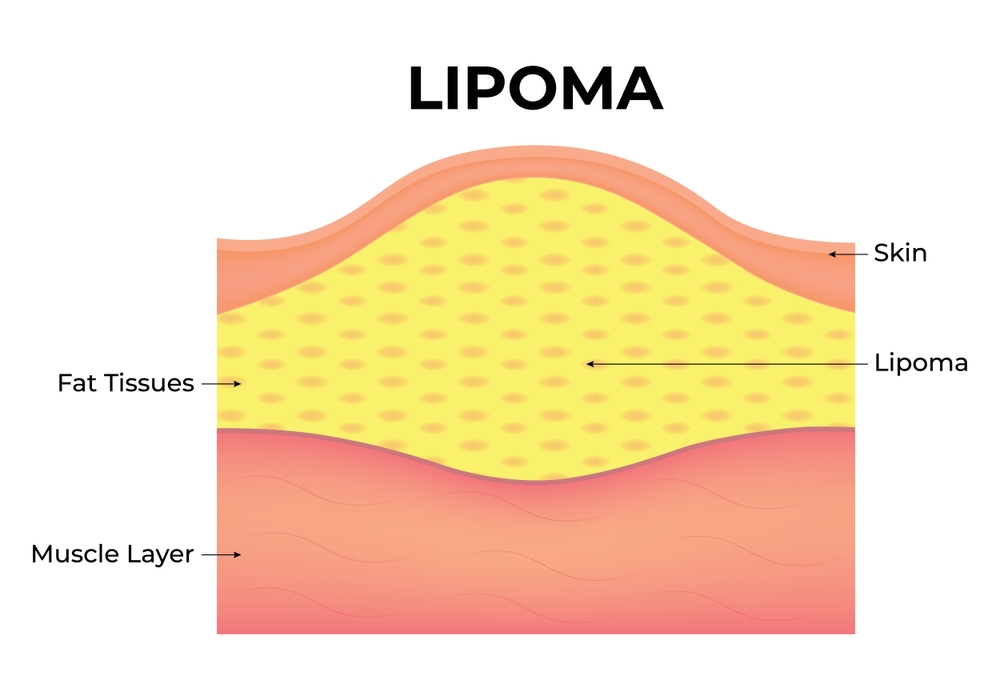 fatty lump under skin