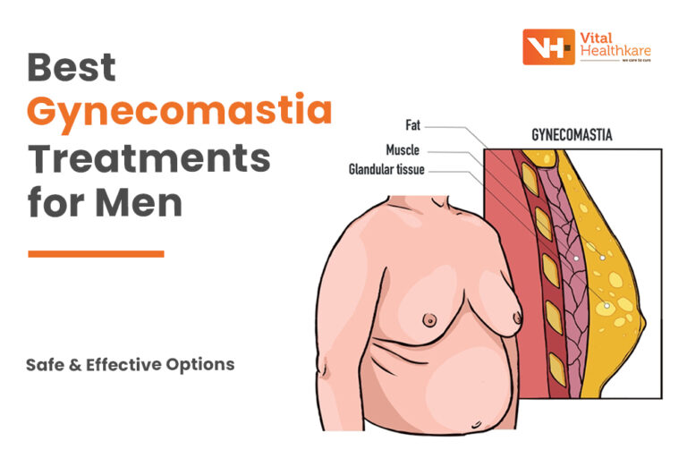 Effective Gynecomastia Treatment for Men