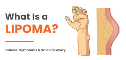 Lipoma Treatment