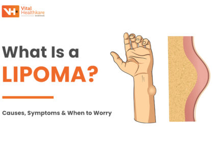 Lipoma Treatment