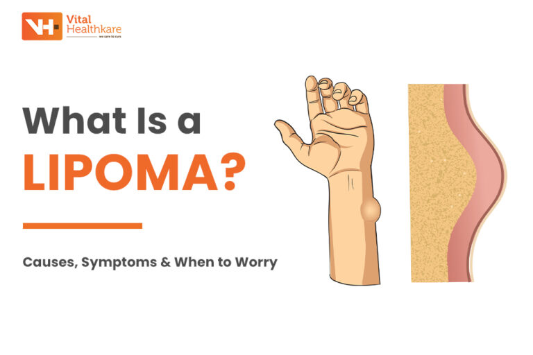 Lipoma Treatment: Causes, Symptoms & Treatment