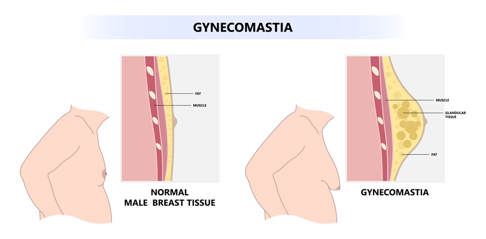 gynecomastia treatment for men