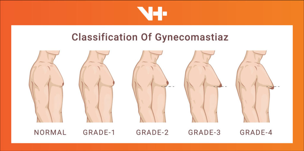 Grades of Gynecomastia