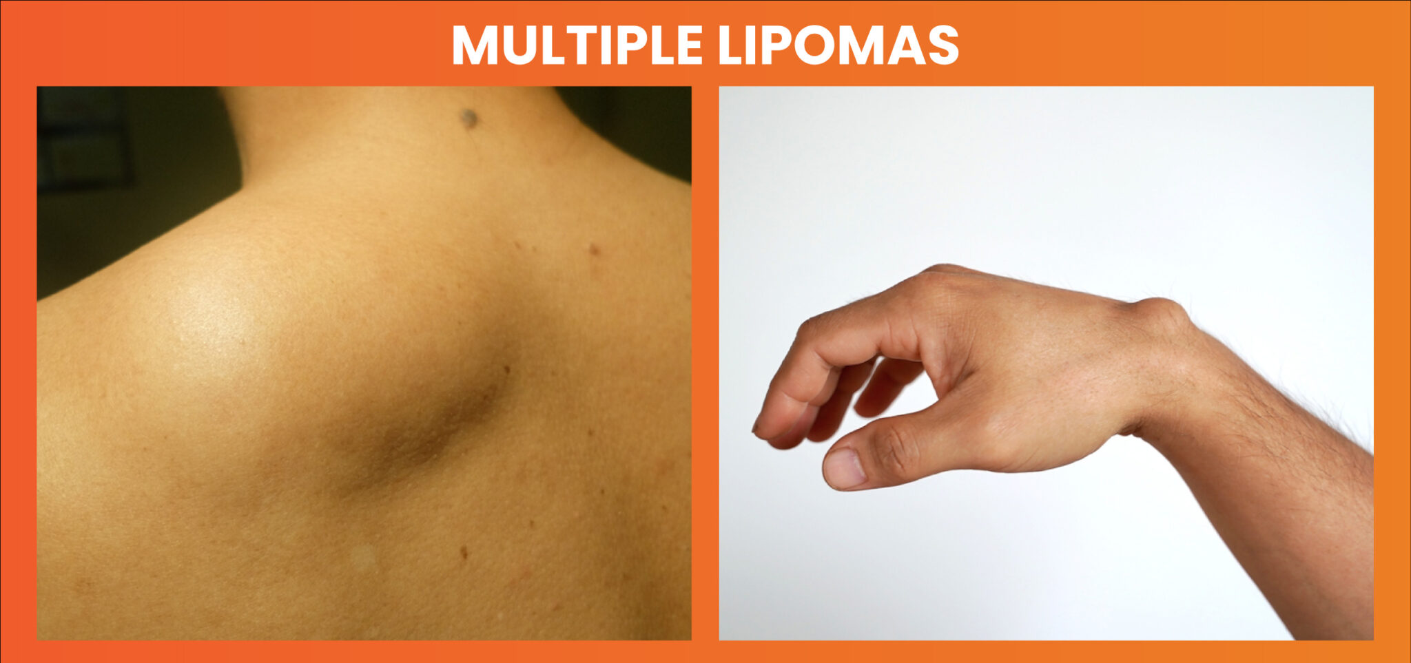 Multiple lipomas on arms and Shoulder
