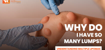 Multiple lipomas visible as small soft lumps on a man's hand