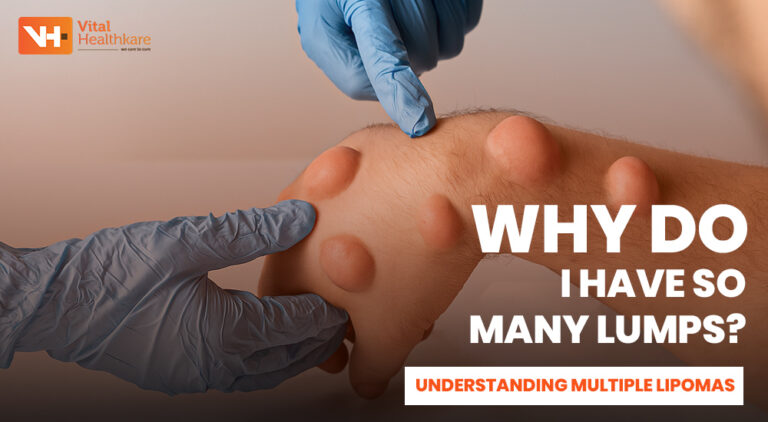 Multiple Lipomas on the Body – Causes, Symptoms & Treatment Options