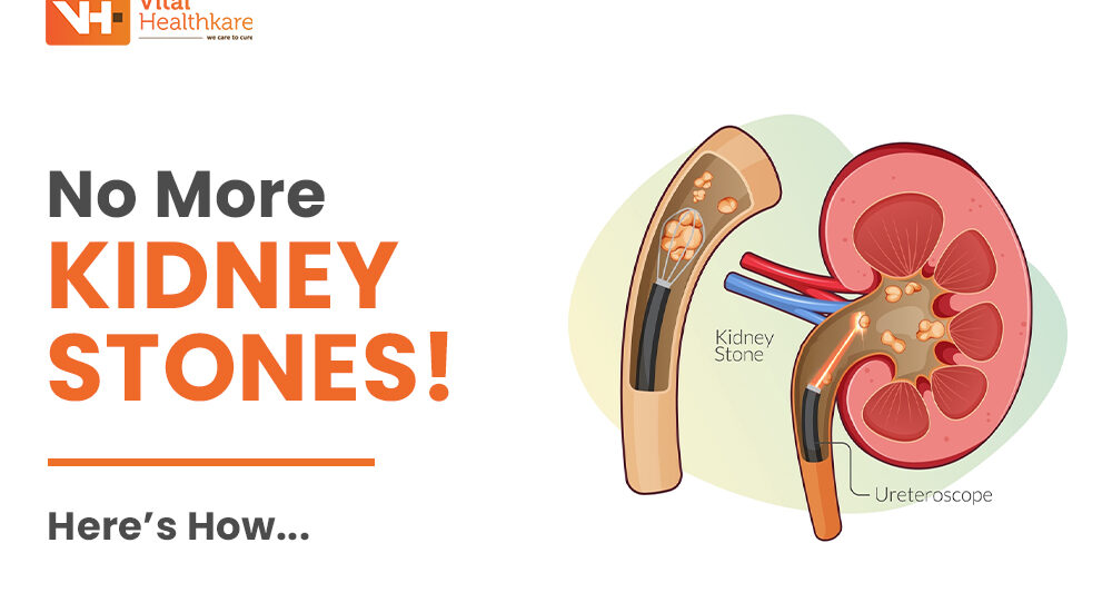 How to Prevent Kidney Stones: