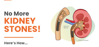 How to Prevent Kidney Stones: