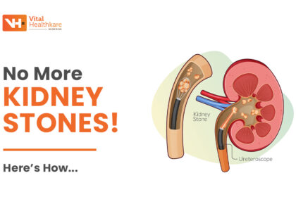 How to Prevent Kidney Stones:
