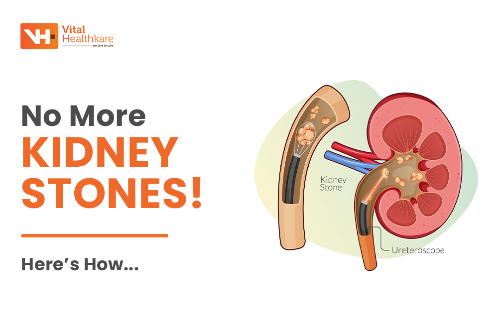 How to Prevent Kidney Stones: