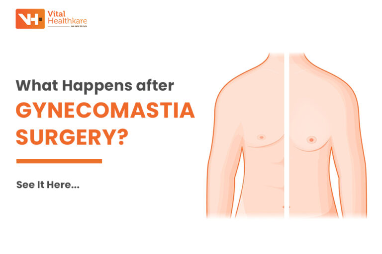 Gynecomastia Surgery Before and After: What to Expect